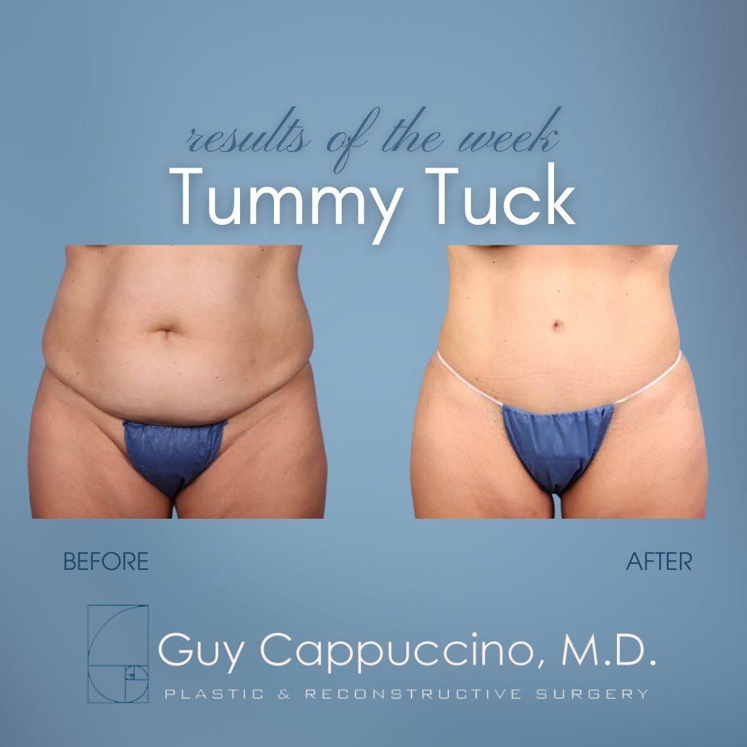 Instagram post by Dr. Guy Cappuccino: A tummy tuck is a life changing procedure. Not only does it remove loose skin caused by weight changes or pregnancy, but it can also be an o…