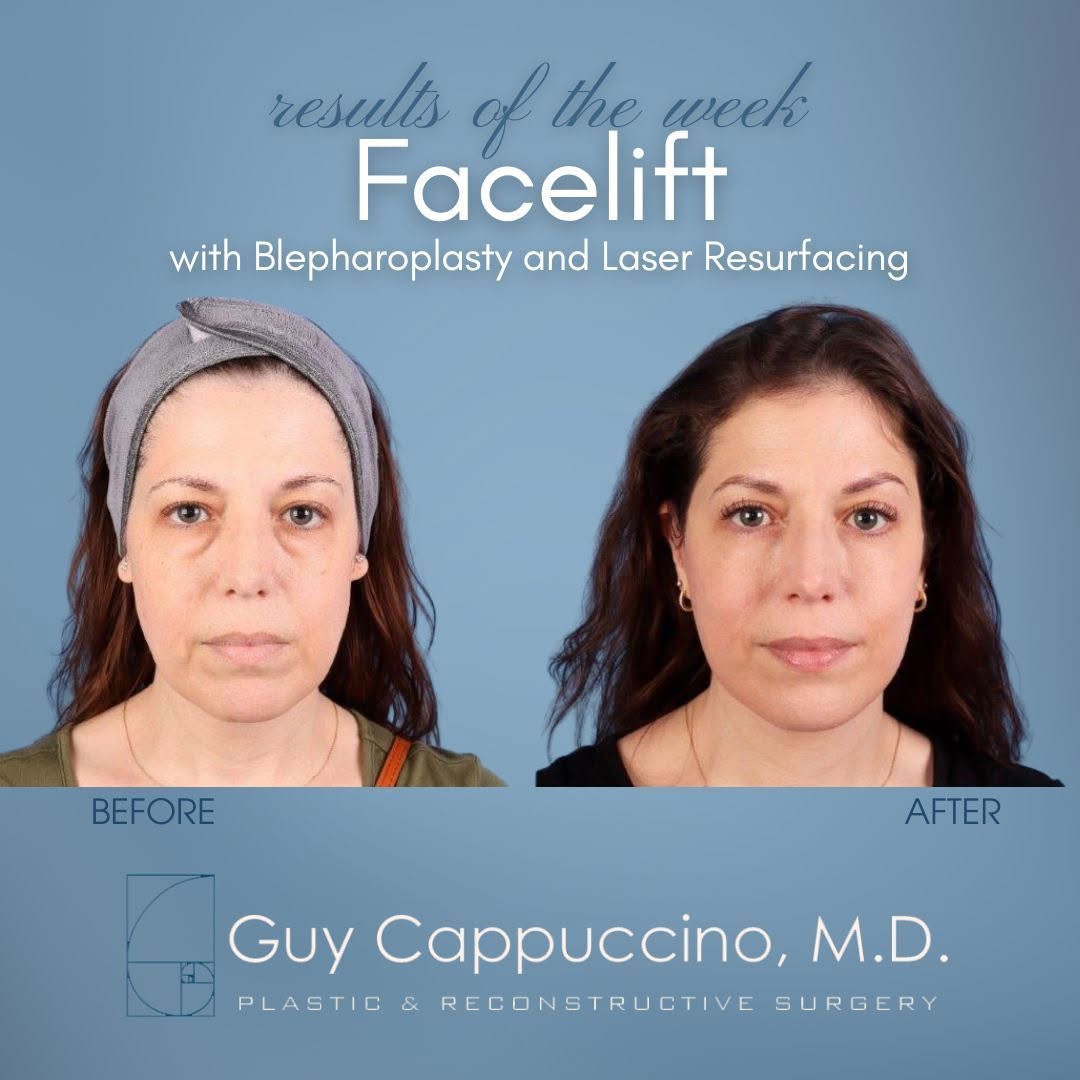Instagram post by Dr. Guy Cappuccino: A facelift and Blepharoplasty can create a more youthful and rested appearance. Our patient loves her results! #drcappuccino #facelift #befo…