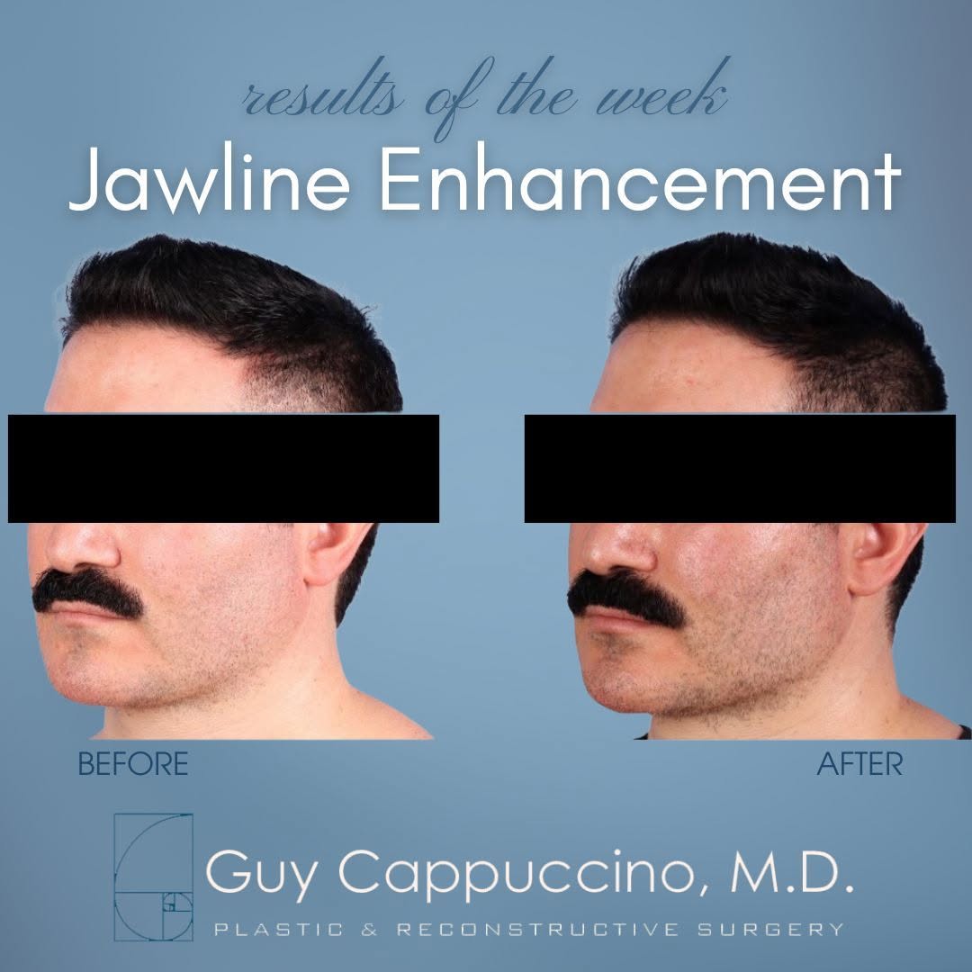 Instagram post by Dr. Guy Cappuccino: Tell us your concerns and trust us to create a custom plan to make you look your best! Our patient wanted a chiseled jawline and we made it …
