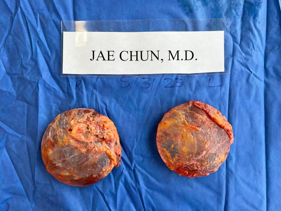 Instagram post by Dr. H. Jae Chun: Total capsulectomy and removal of intact submuscular saline implants. 5/31/2023. #enbloccapsulectomy #bii #breastimplantillness #explantsurg…