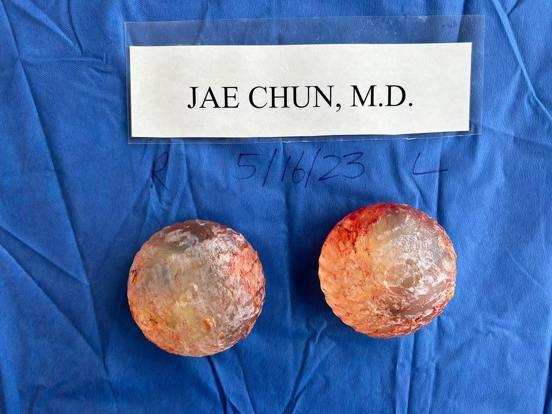 Instagram post by Dr. H. Jae Chun: En-bloc total capsulectomy and removal of intact submuscular saline implants. 5/16/2023. Thin capsules. #enbloccapsulectomy #bii #breastimpl…
