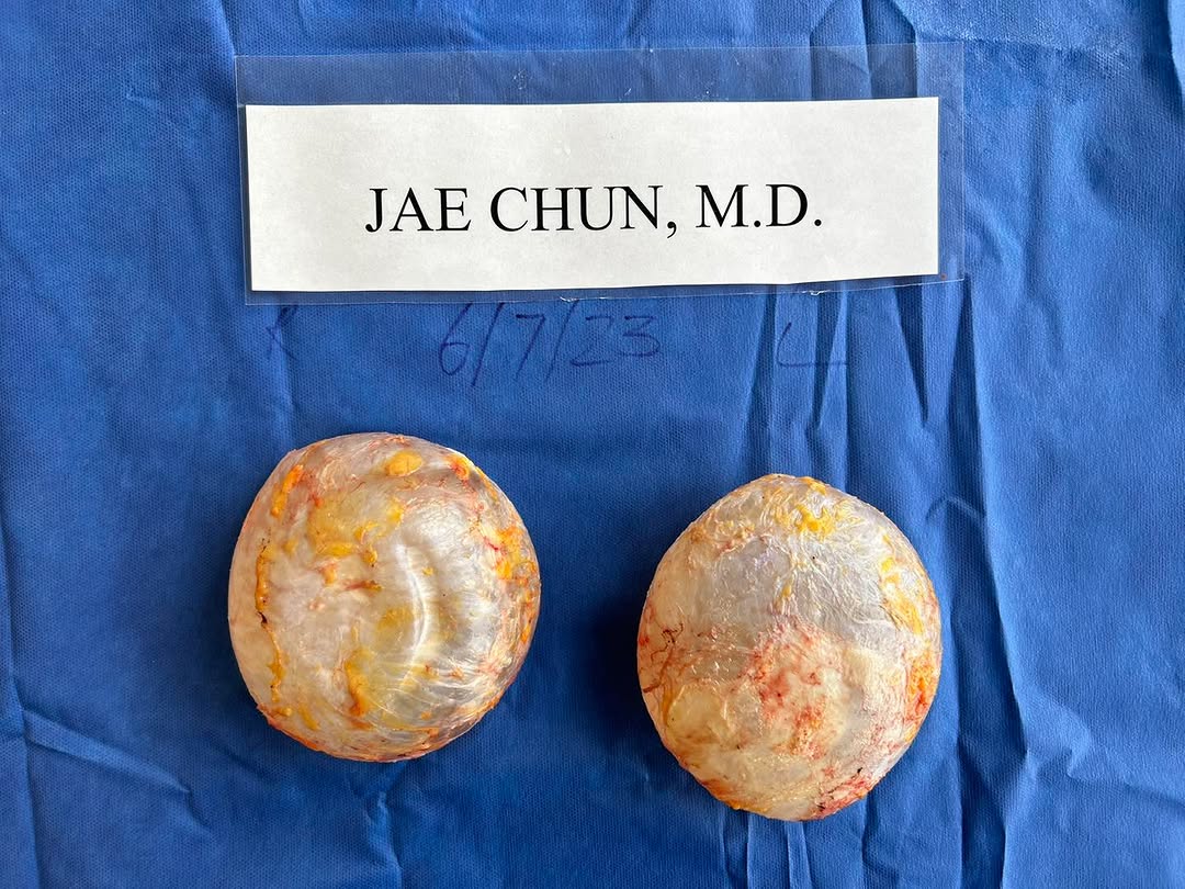 Instagram post by Dr. H. Jae Chun: En-bloc total capsulectomy and removal of intact silicone implants. Also removed previously placed Alloderm (cadaver skin). 6/7/2023. #enblo…