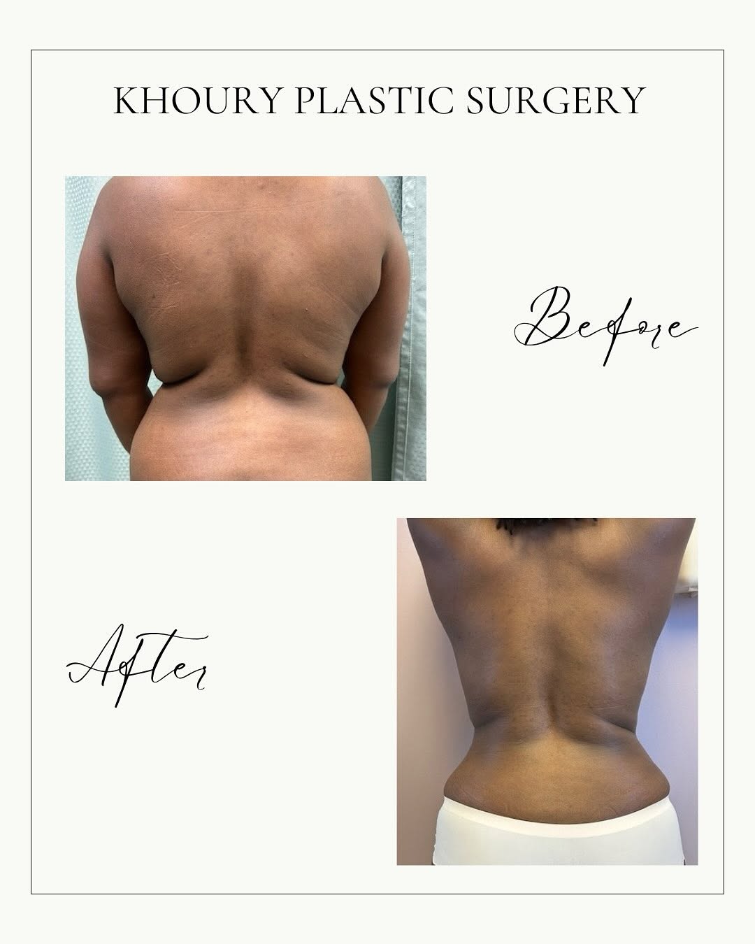 Instagram post by Dr. Habib Khoury: Check out the amazing before and after results of this tummy tuck!