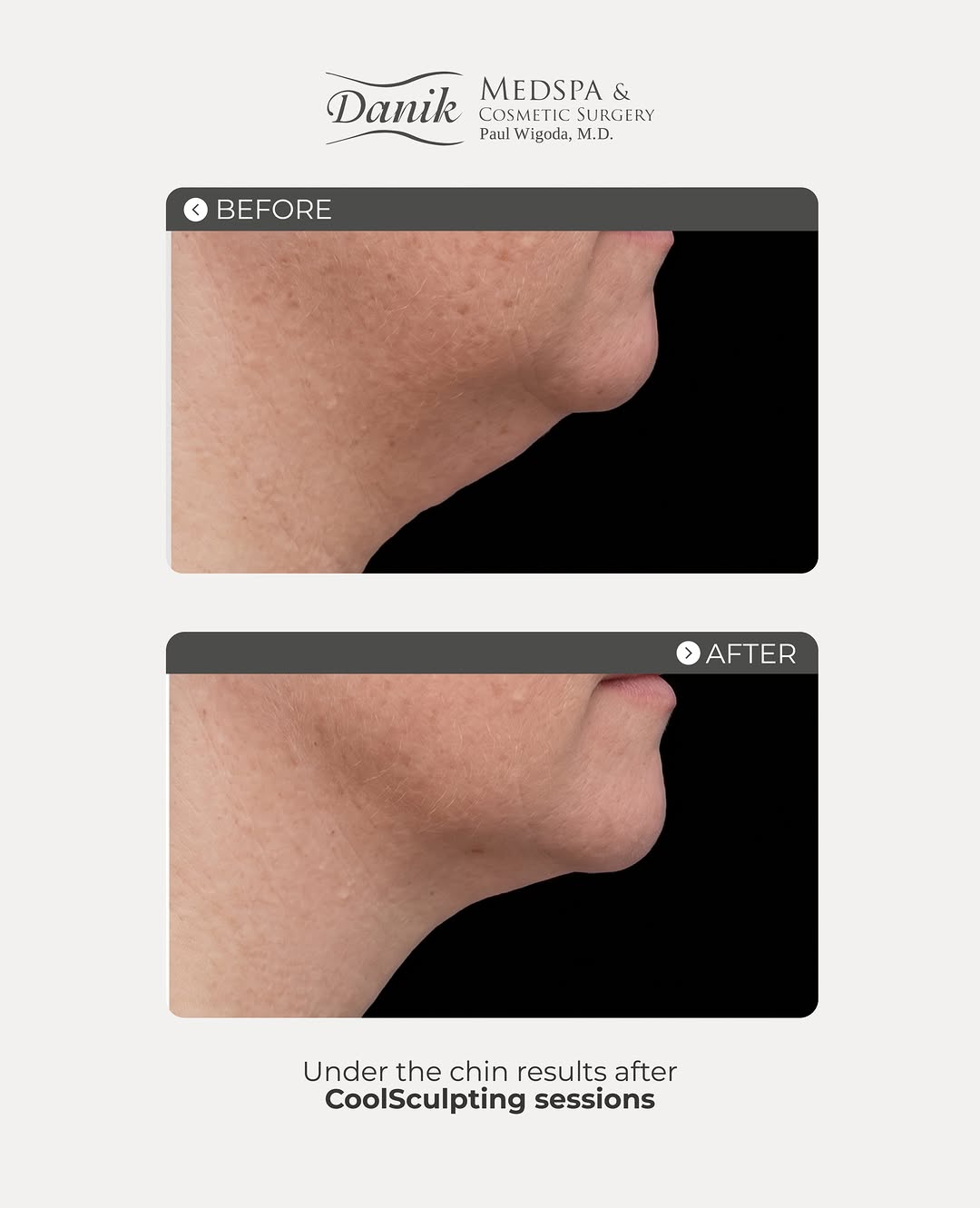 Instagram post by Dr. Hal Michael Bass: Before & After ✨ A more defined profile with CoolSculpting® under the chin. By targeting and reducing stubborn fat cells, CoolSculpting can …