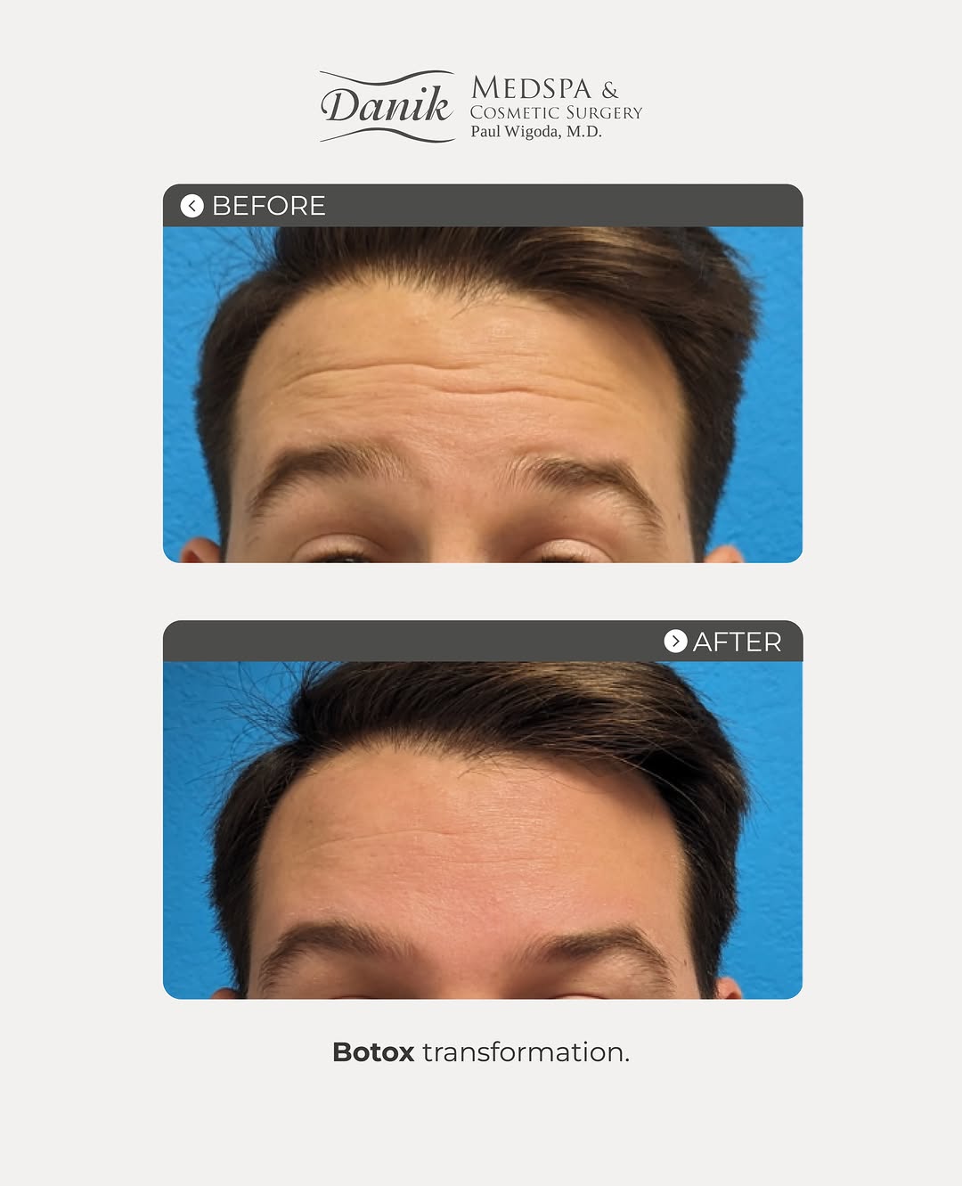 Instagram post by Dr. Hal Michael Bass: A smoother, more refreshed look with Botox ✨ This before & after shows a subtle forehead transformation designed to soften the appearance of…
