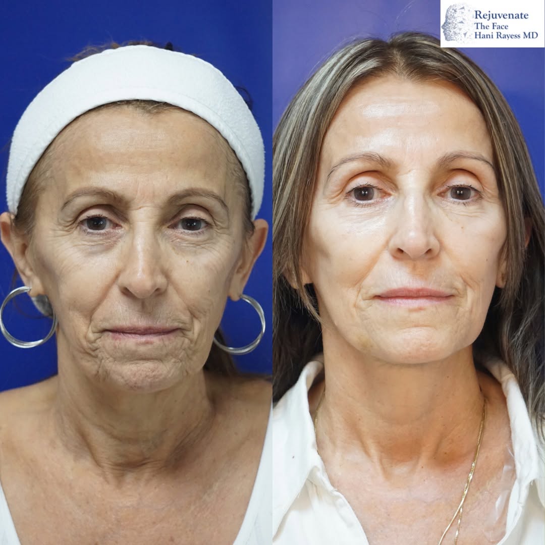 Instagram post by Dr. Hani Rayess: Sonia is one of the toughest ladies I know! 💪 She came to us looking for a refresh, wanting to look younger but still like herself. Now, 5 …