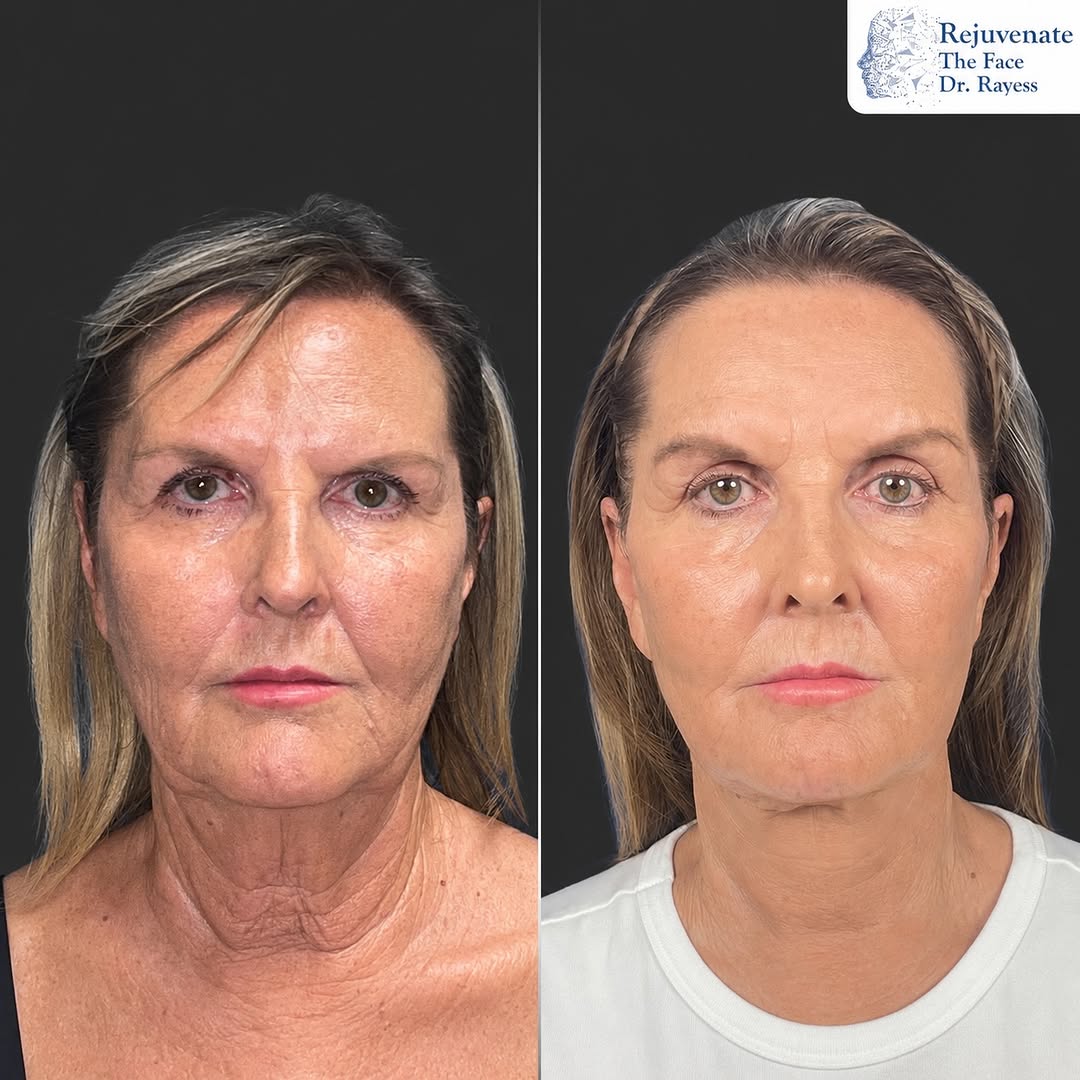 Best deep plane facelift St. Petersburg