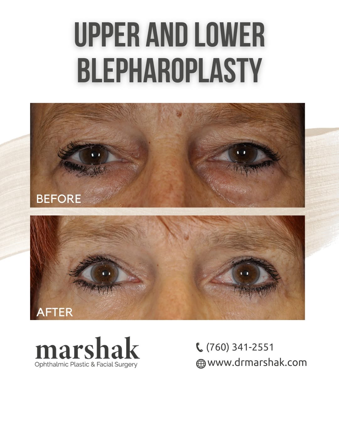 Instagram post by Dr. Harry Marshak: Check out this stunning before and after of upper and lower blepharoplasty. 👀 Notice how subtle changes can make a big difference in refres…