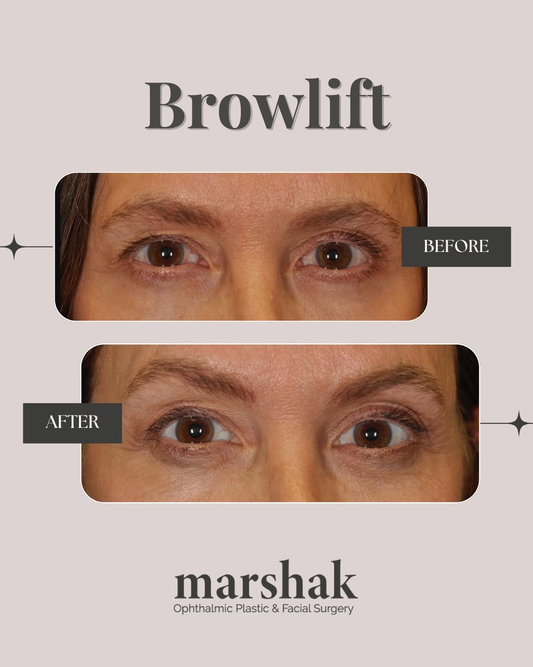 Instagram post by Dr. Harry Marshak: Check out this browlift before and after! Subtle changes can make a big difference in refreshing your look. ✨ Curious if this could be right…