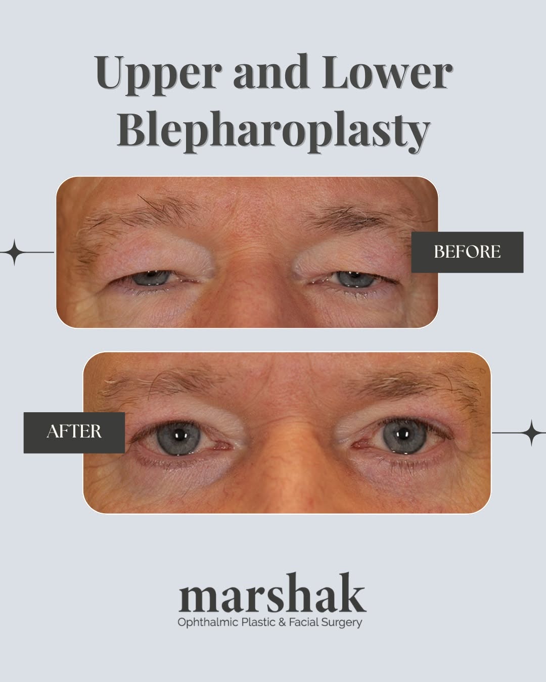 Instagram post by Dr. Harry Marshak: A subtle change around the eyes can make a big difference. ✨ Take a look at this before and after of upper and lower blepharoplasty. Thinkin…