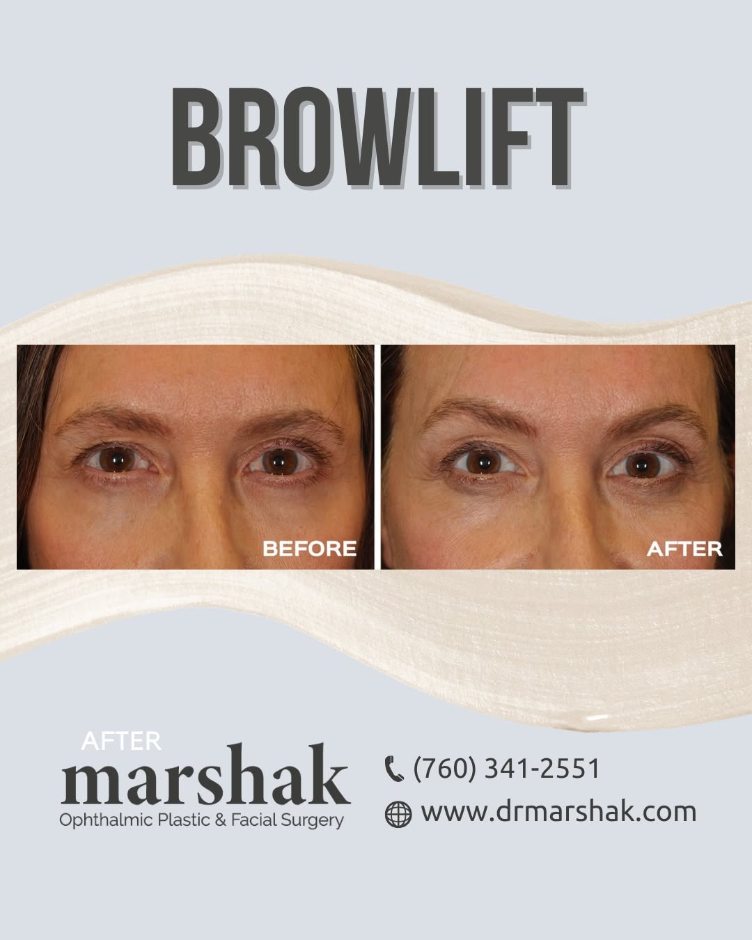 Instagram post by Dr. Harry Marshak: A subtle lift can make a noticeable difference. This browlift result highlights a more refreshed and naturally rested look. ✨ Curious if thi…
