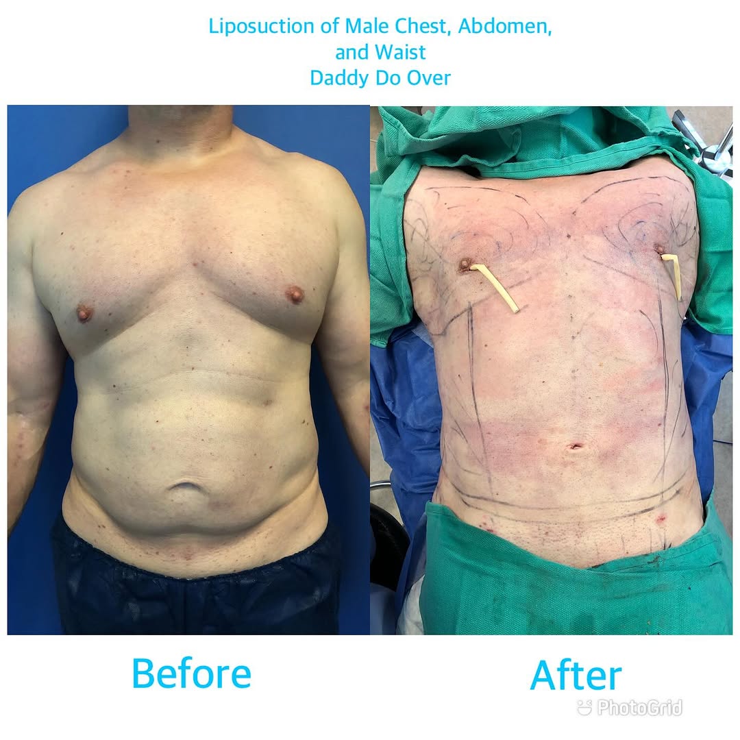 Instagram post by Dr. Harry T. Haramis: Watch today’s Vaser liposuction today on SnapChat - Great contouring of both the chest and abdomen - RealDrFaceUSA. #vaser #lipo #liposuctio…