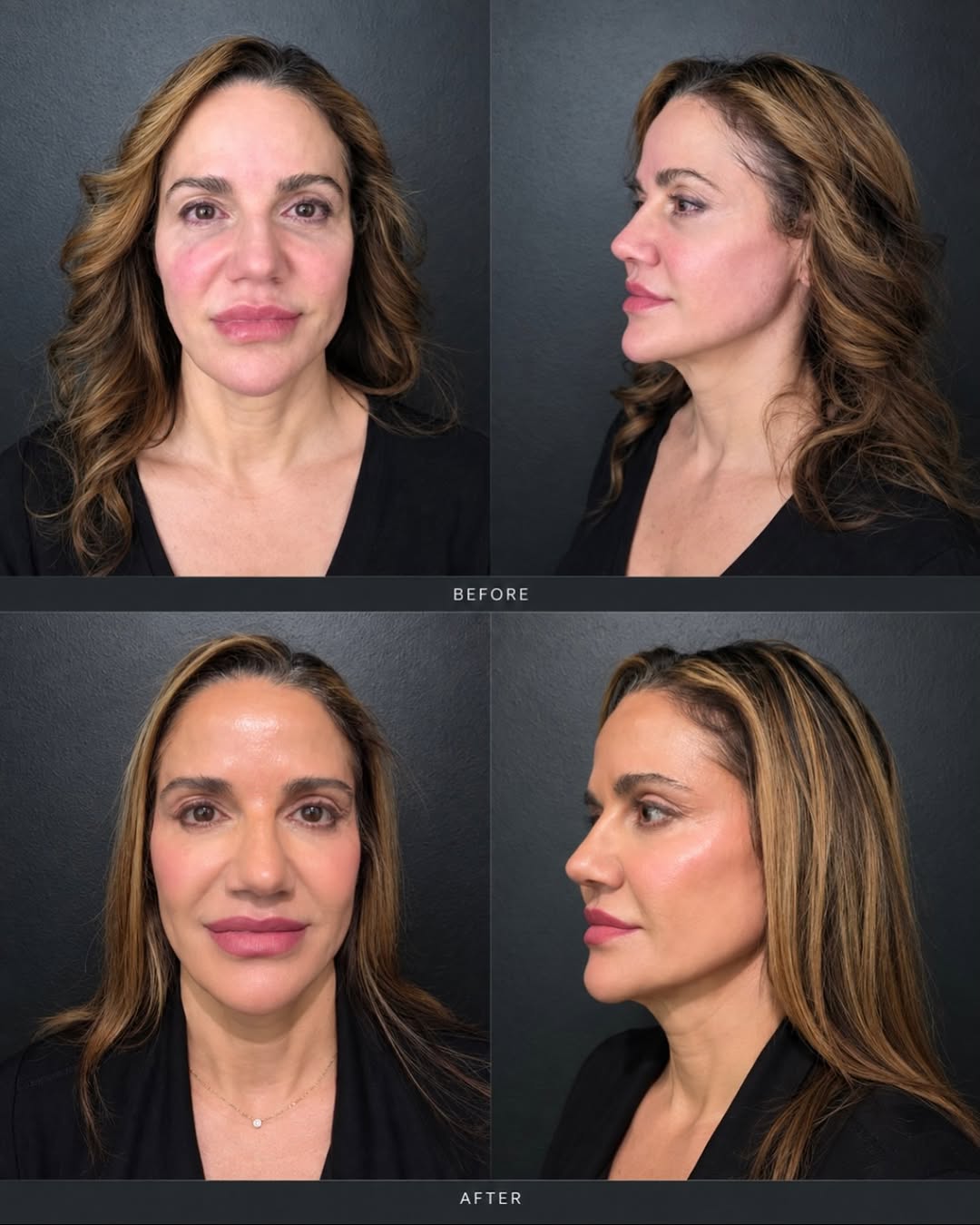 Instagram post by Dr. Harry V. Wright: Another beautiful transformation by Elsa🤍 This glow wasn’t built in just one treatment. The result? Smoother texture, more even tone & beau…