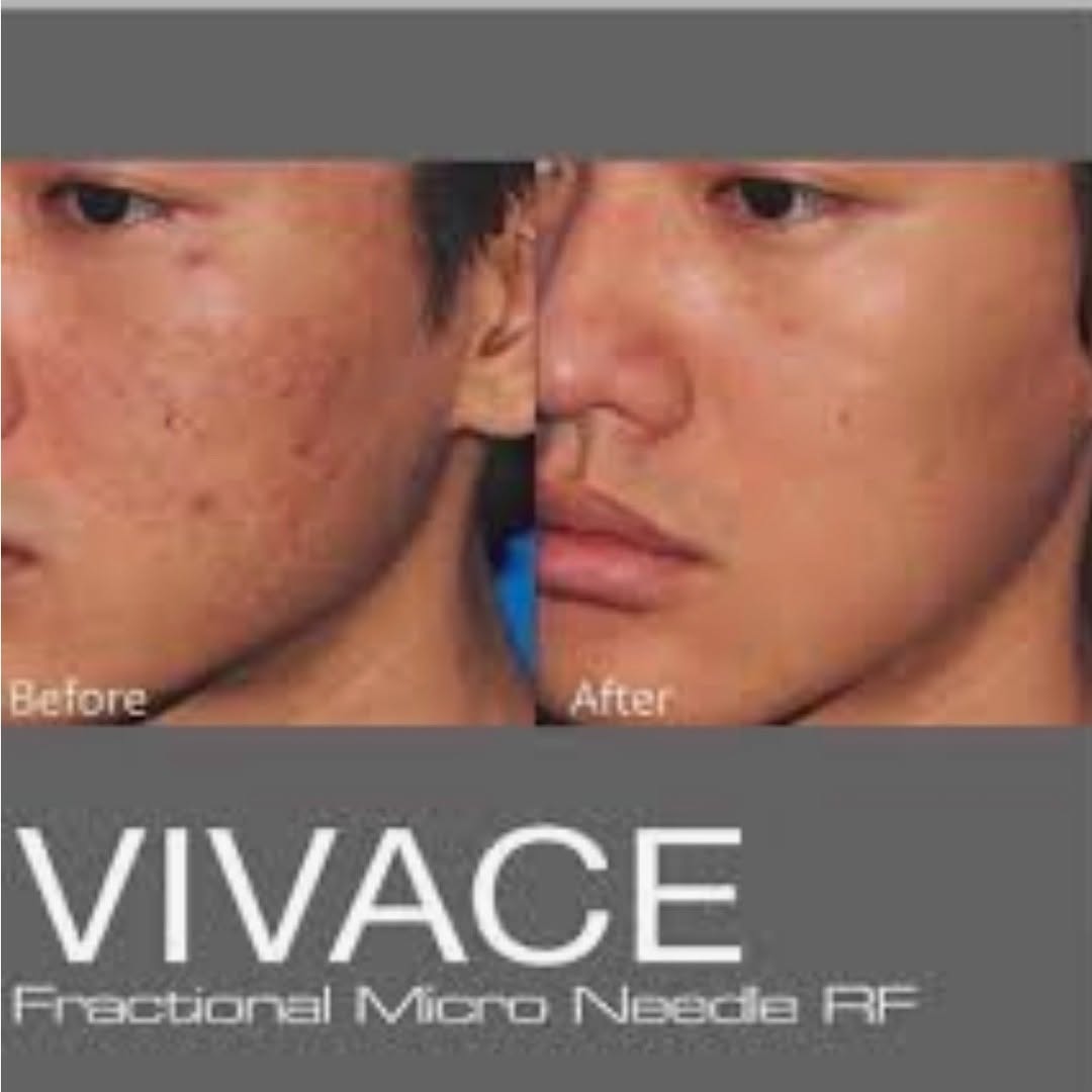Instagram post by Dr. Haydee Docasar: Is Vivace Good For Acne Scars. Absolutely! Vivace Is an Excellent minimally invasive treatment for Post-acne Scars. It Stimulates the Repair…