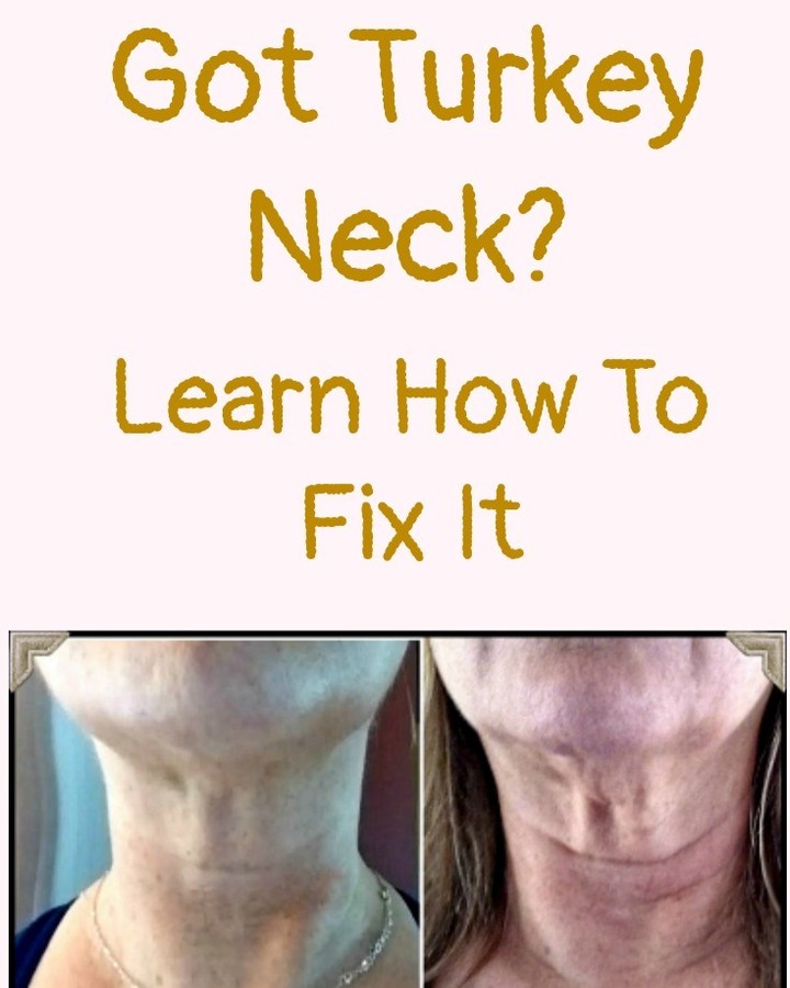 Instagram post by Dr. Haydee Docasar: Got Turkey Neck?!?! Dr. Docasar has The Solution to Stimulate The Collagen! The Vivace Experience of Radio Frequency stimulates the producti…