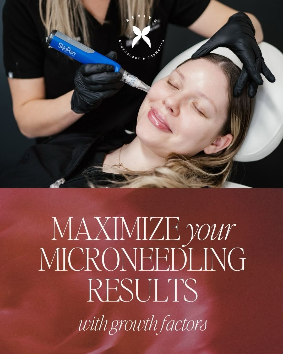 Instagram post by Dr. Hazem Elshoreya: Microneedling 🤝 PRP — the ultimate skin rejuvenation duo. Microneedling helps stimulate your skin’s natural collagen production, while PRP …