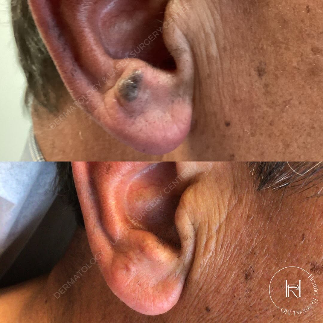 Instagram post by Dr. Heather M. Richmond: Cosmetic excision of a mole on the earlobe. Nice result on the day of suture removal with no significant distortion of the shape of the ear.…
