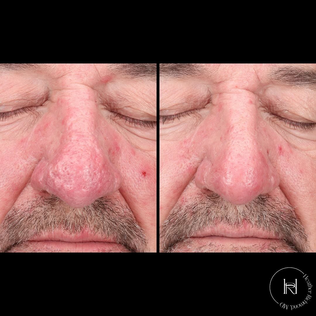 Instagram post by Dr. Heather M. Richmond: UltraClear erbium ablative laser resurfacing for rhinophyma! Rhinophyma is a subtype of rosacea that causes thickening of the skin of the no…