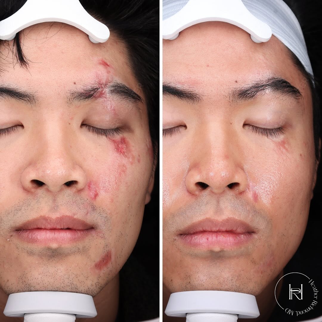 Instagram post by Dr. Heather M. Richmond: Laser treatment is game changing for scars. This patient is 1 month post 6 treatments with pulsed dye laser (Vbeam) and 3 treatments with Fr…
