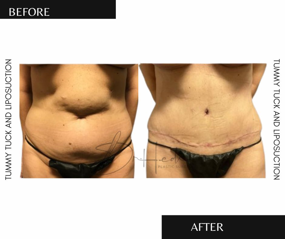 Instagram post by Dr. Hedieh Arbabzadeh: ✨ A Transformation Worth Celebrating! ✨ A tummy tuck (abdominoplasty) can help create a smoother, more defined abdominal profile by removing…