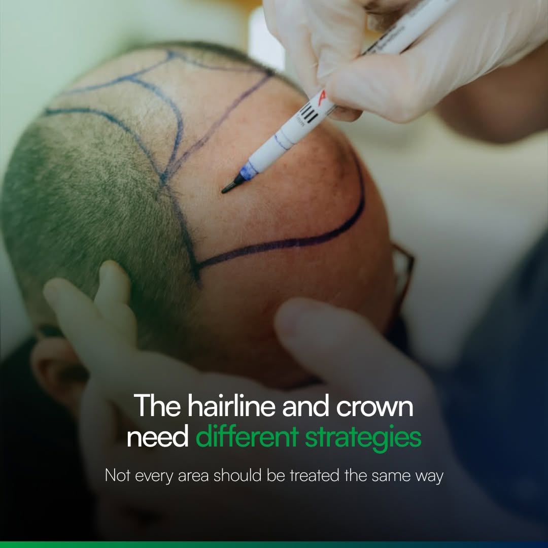 Instagram post by Dr. Heidi Regenass: The hairline and crown require different strategies — because great hair restoration is never one-size-fits-all. The hairline needs precisio…