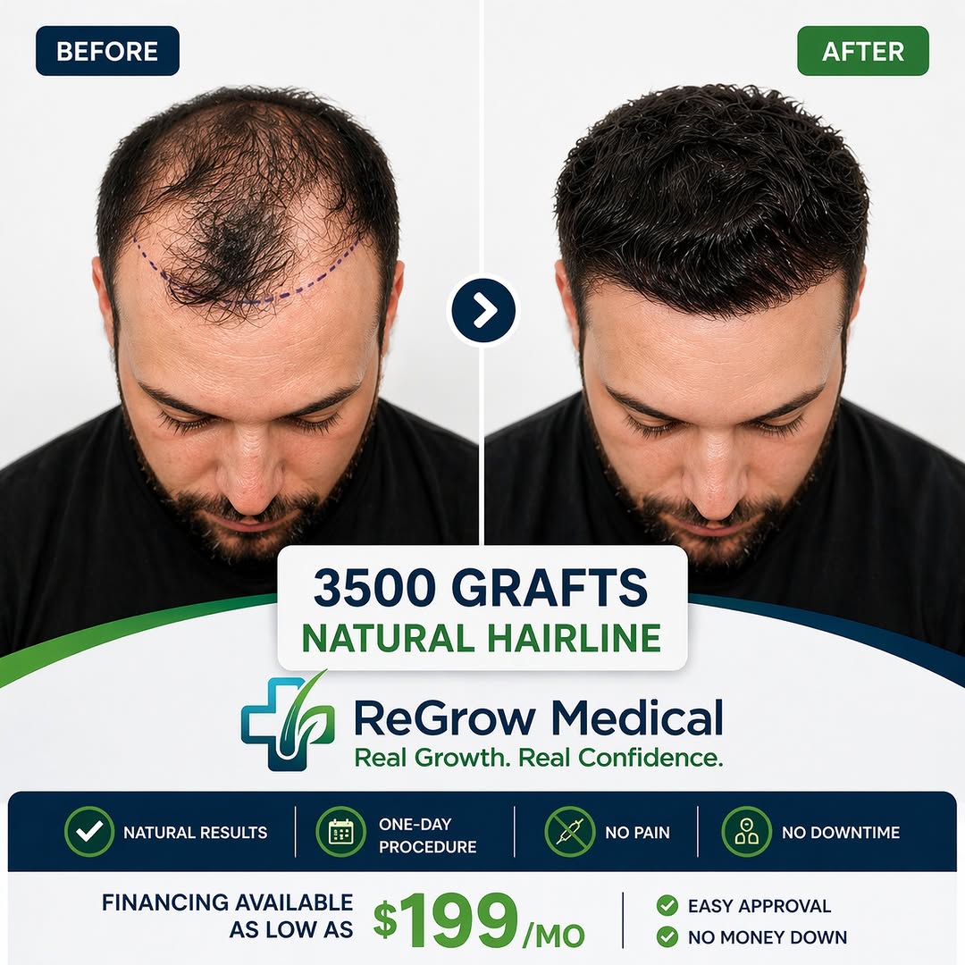 Instagram post by Dr. Heidi Regenass: 3,500 grafts. Natural hairline. Real transformation. 🌱 This result shows what thoughtful hairline design and strategic graft placement can …