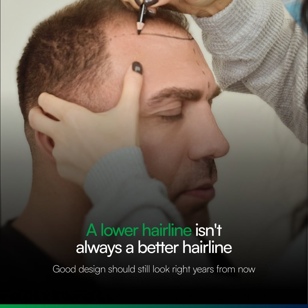 Instagram post by Dr. Heidi Regenass: A lower hairline isn’t always a better hairline. The goal of hair restoration isn’t simply to bring the hairline down — it’s to design one t…