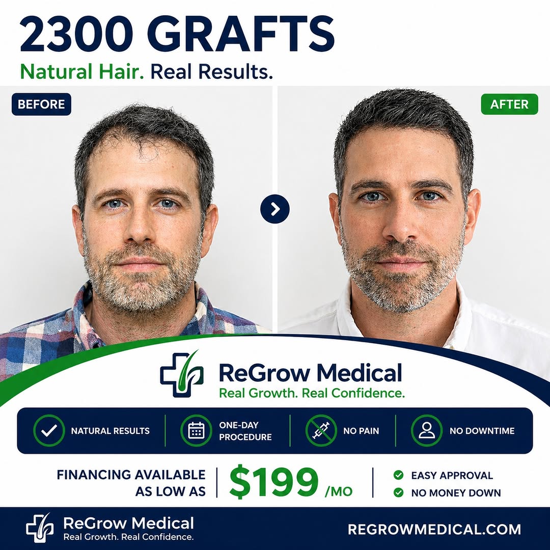 Instagram post by Dr. Heidi Regenass: 2,300 grafts. A refined hairline. A natural transformation. 🌱 Sometimes the best results aren’t about using the most grafts — they’re about…