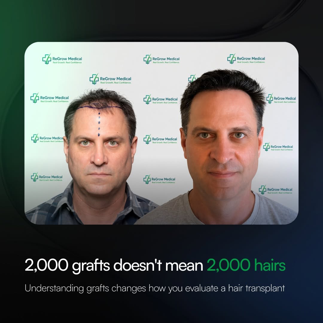 Instagram post by Dr. Heidi Regenass: 2,000 grafts does not mean 2,000 hairs. 🌱 A graft is a follicular unit, and each graft can contain one or multiple hairs. That’s why graft …