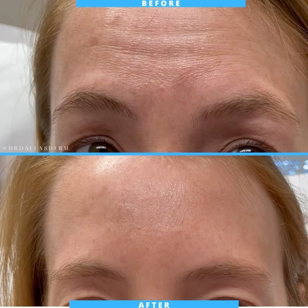 Instagram post by Dr. Helen Kaporis: Less lines, more radiance! 🌟 Our patient desired to soften the lines and signs of aging while still being able to express themselves. Befor…