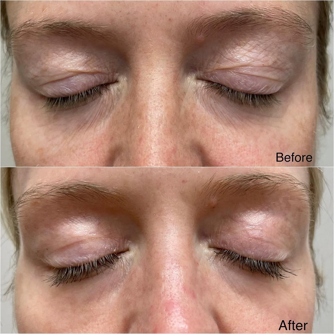 Instagram post by Dr. Helen Kaporis: Skin resurfacing after one session of fractionated Co2 laser. Before and after pics 4 months apart. Co2 laser results in new collagen produc…
