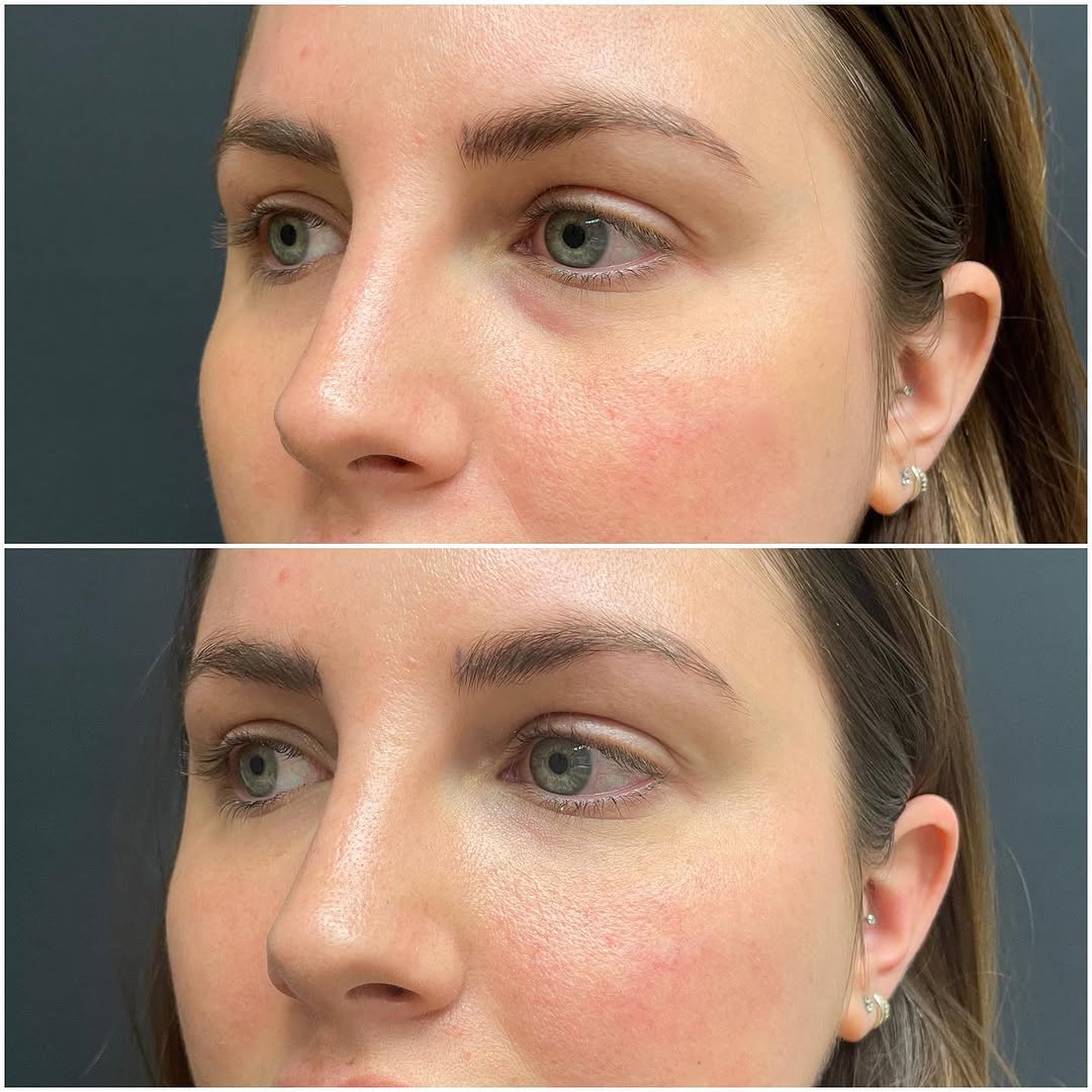 Instagram post by Dr. Helen Kaporis: Eye rejuvenation using Restylane EYELIGHT. Restylane EYELIGHT is a dermal filler indicated for the improvement of infraorbital hollowing (un…