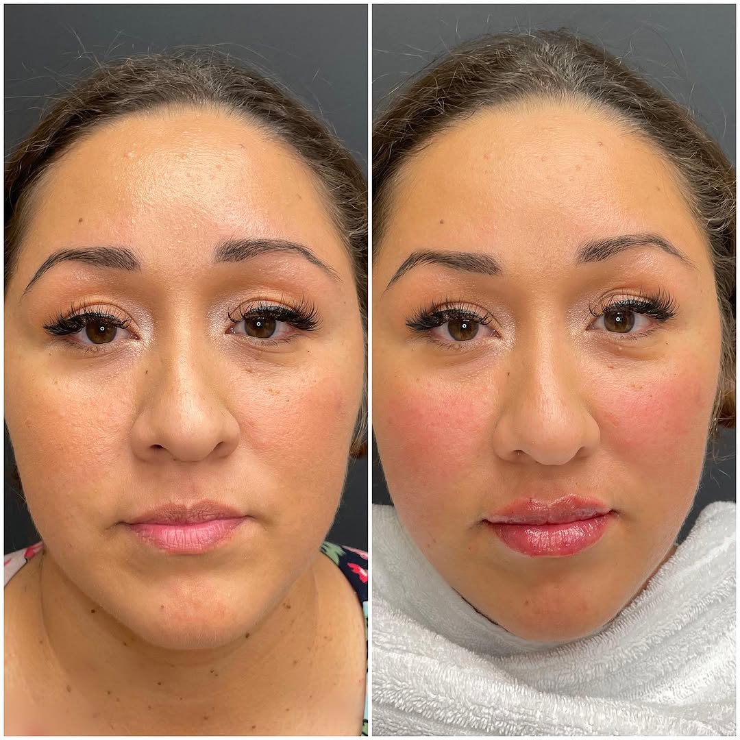 Instagram post by Dr. Helen Kaporis: Lip Glow Up! One syringe of Restylane Kysse for this natural beauty.💋 #lipfiller #lipglow #aesthetic #beautytips #skincare #dallasblogger #…