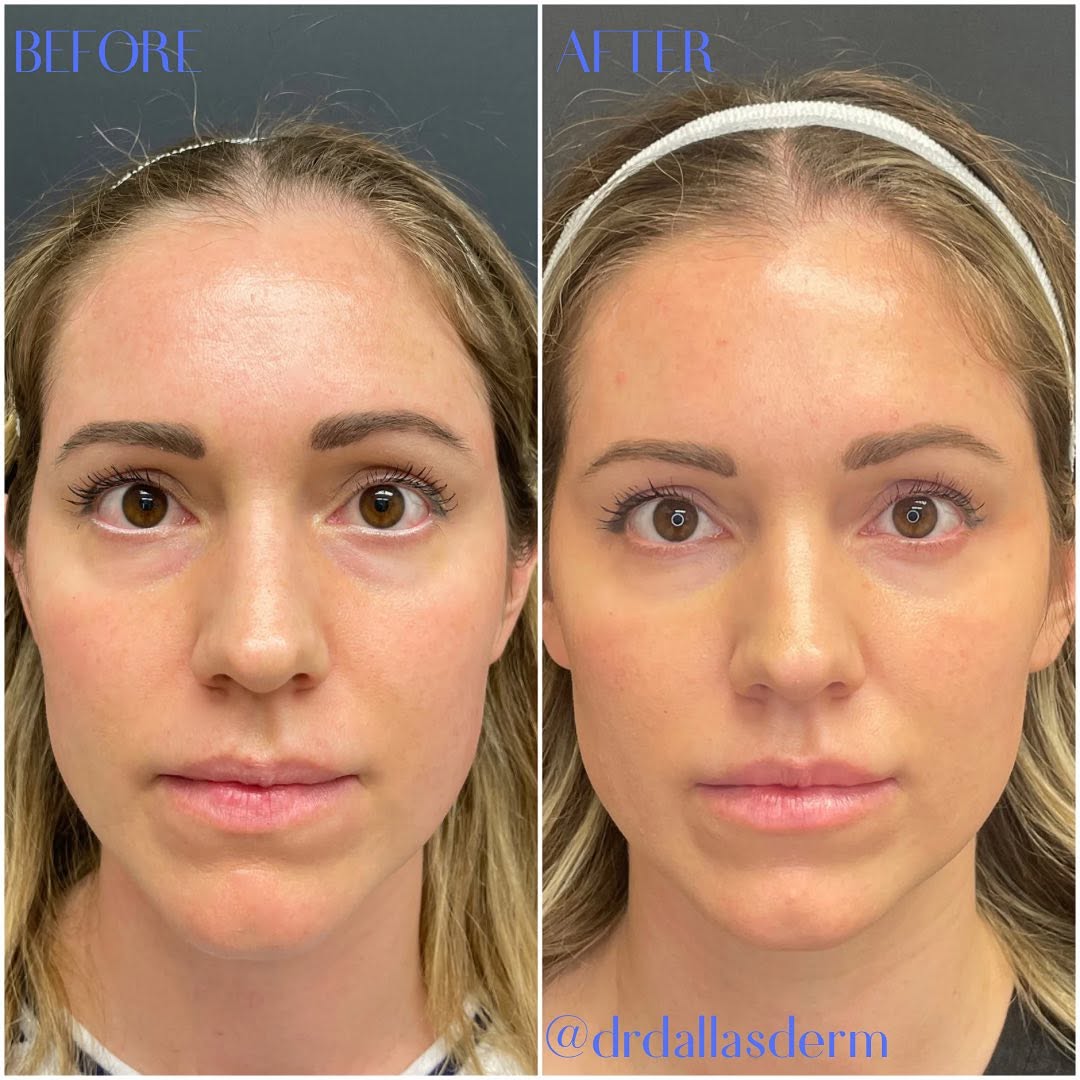 Instagram post by Dr. Helen Kaporis: ⭐️Subtle placement of filler can make a world of difference. This glowing beauty looks overall well rested and feels like a better version o…
