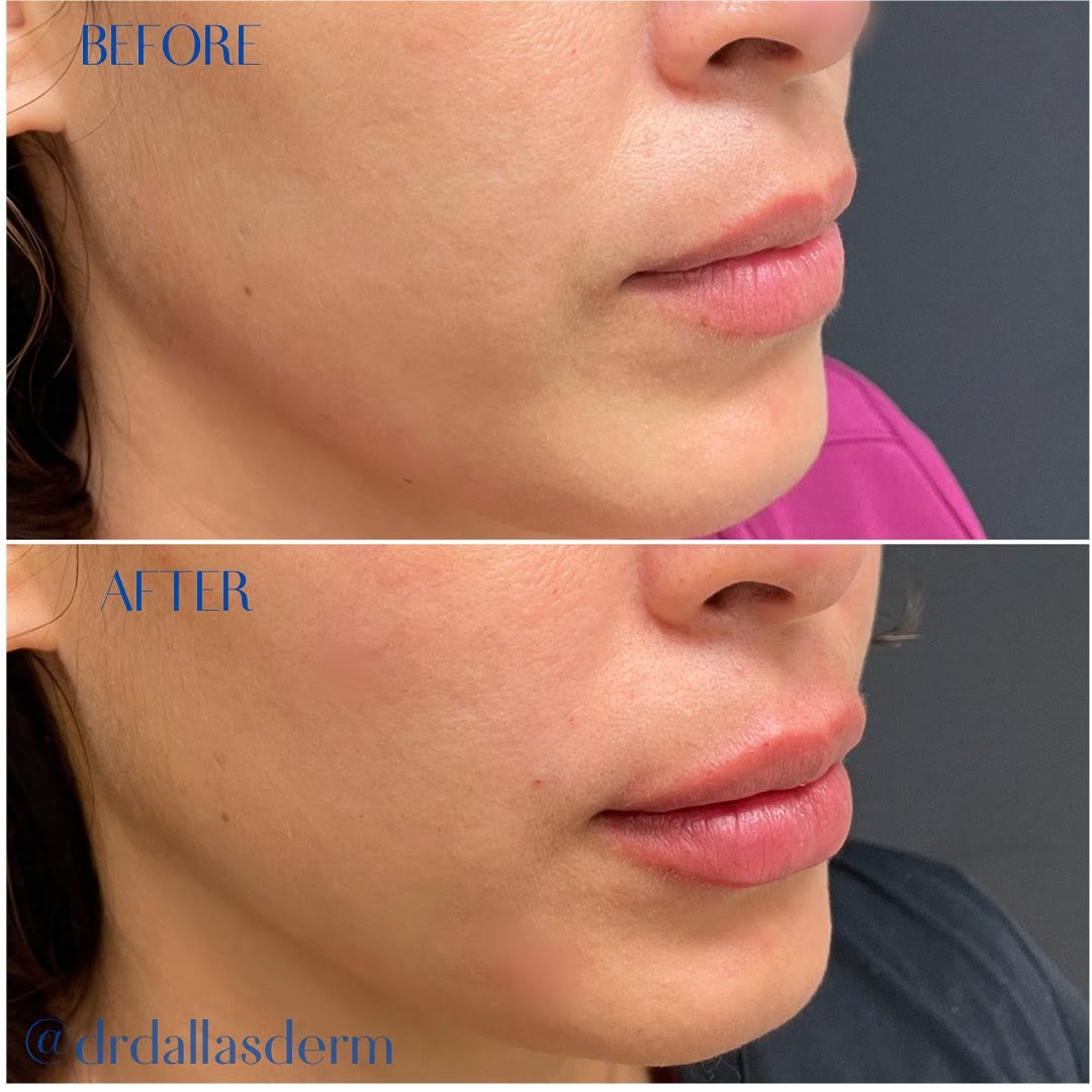 Instagram post by Dr. Helen Kaporis: From subtle to stunning ✨ Enhancing lips with HA filler for a fuller, yet natural look 💋 #LipGoals #NaturalPlump #BeforeAndAfter