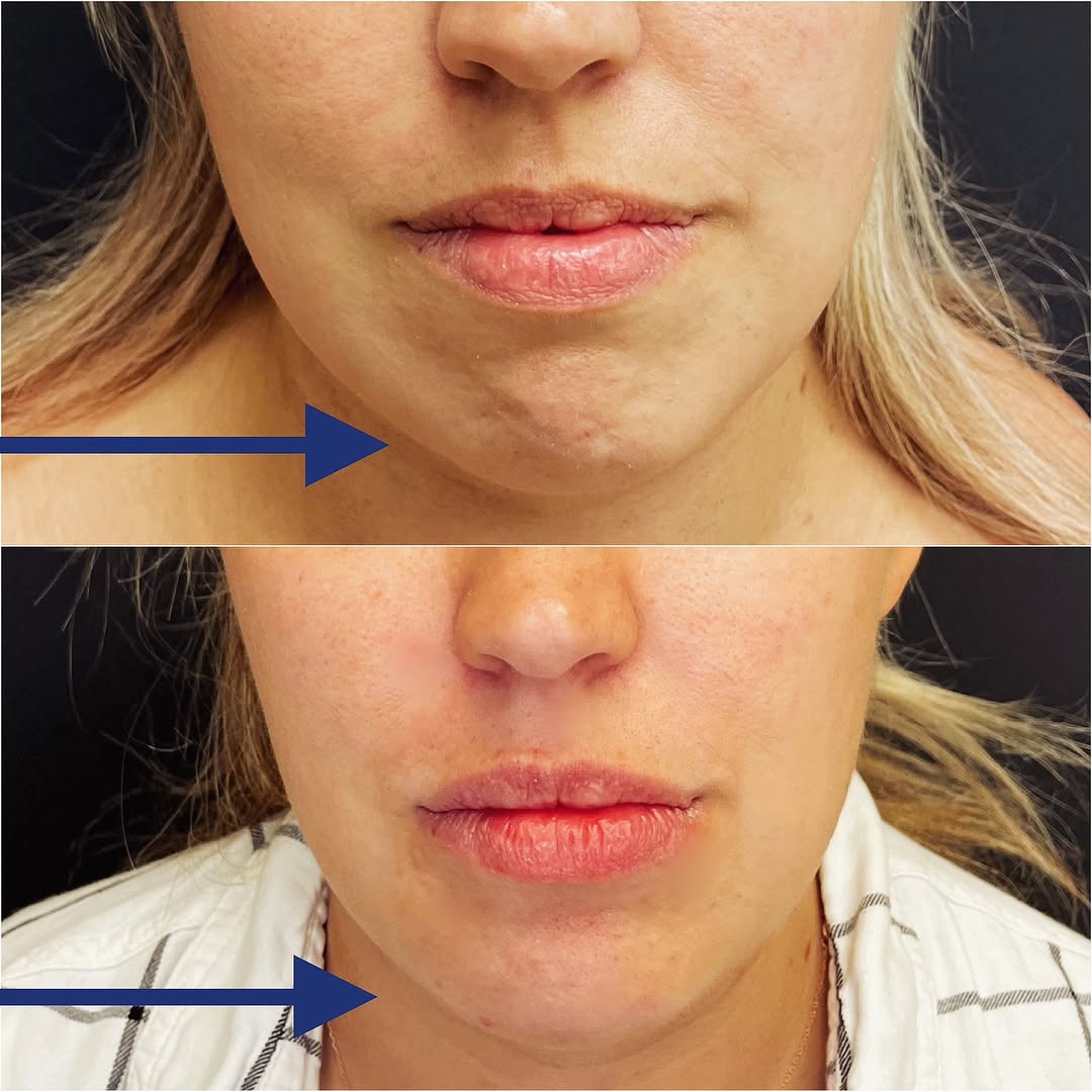 Instagram post by Dr. Helen Kaporis: Transformed and Thrilled! 🌟 Correction of the chin and mandible asymmetry with hyaluronic acid filler and neurotoxin. Artfully balanced pro…