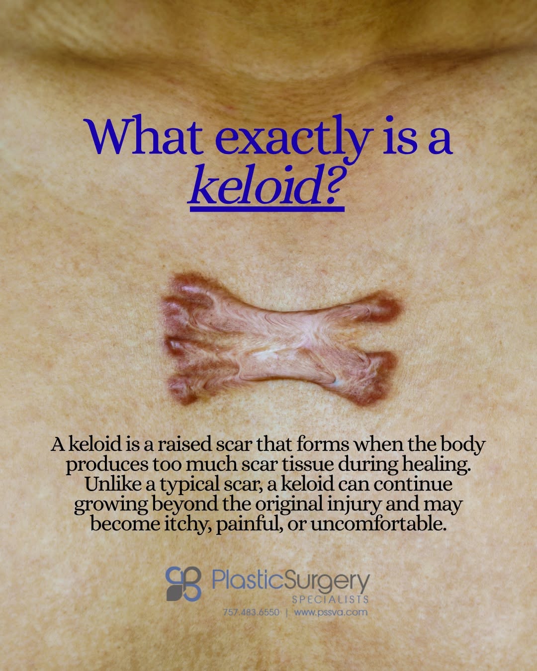 Instagram post by Dr. Helena Guarda: 🩹 Keloid School: Lesson #1 What exactly is a keloid? A keloid is a raised scar that can grow beyond the original injury. It may become thic…