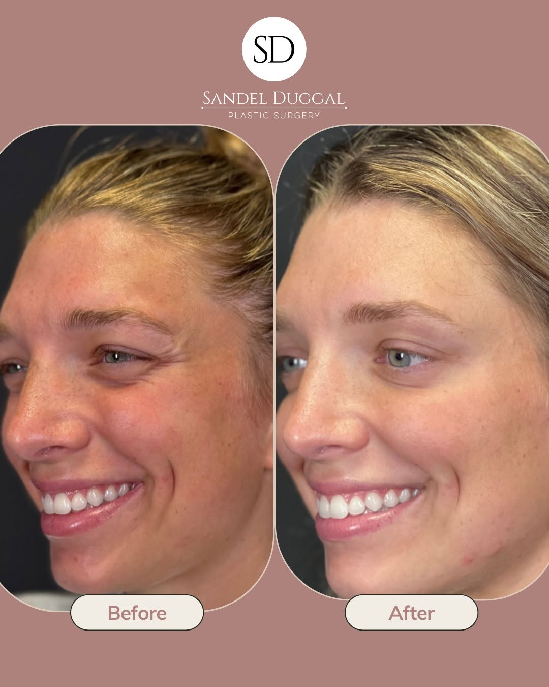 Instagram post by Dr. Henry Daniel Sandel IV: A little tox. A lot of difference. ✨ Bailey’s clients wanted a refreshed, natural-looking result without looking overdone, and that’s always…