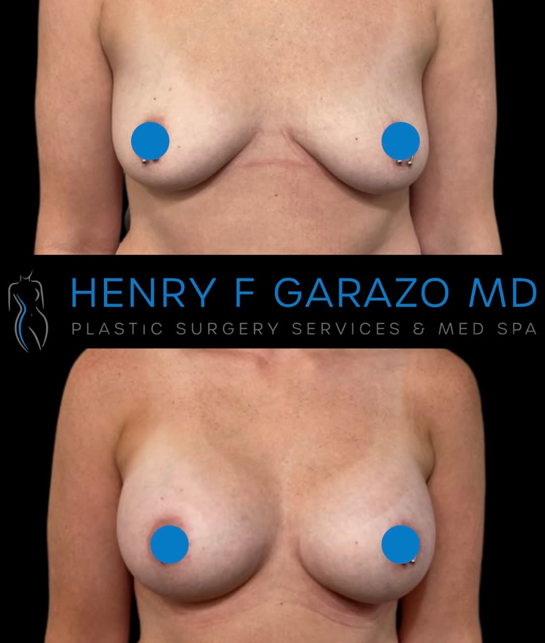 Instagram post by Dr. Henry F. Garazo: This beautiful 34-year-old patient is just 6 weeks after her breast augmentation and already loving her results! After breastfeeding two chi…