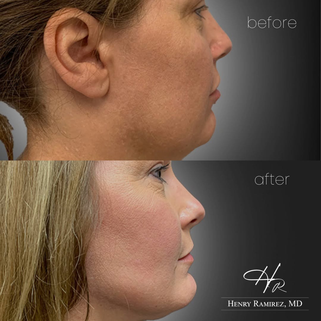 Instagram post by Dr. Henry Ramirez: A fabulous before and after FaceTite treatment! ✨💗 #aestheticstreatment #skincaretreatment #southernoklahoma #FaceTite #FacialTreatment