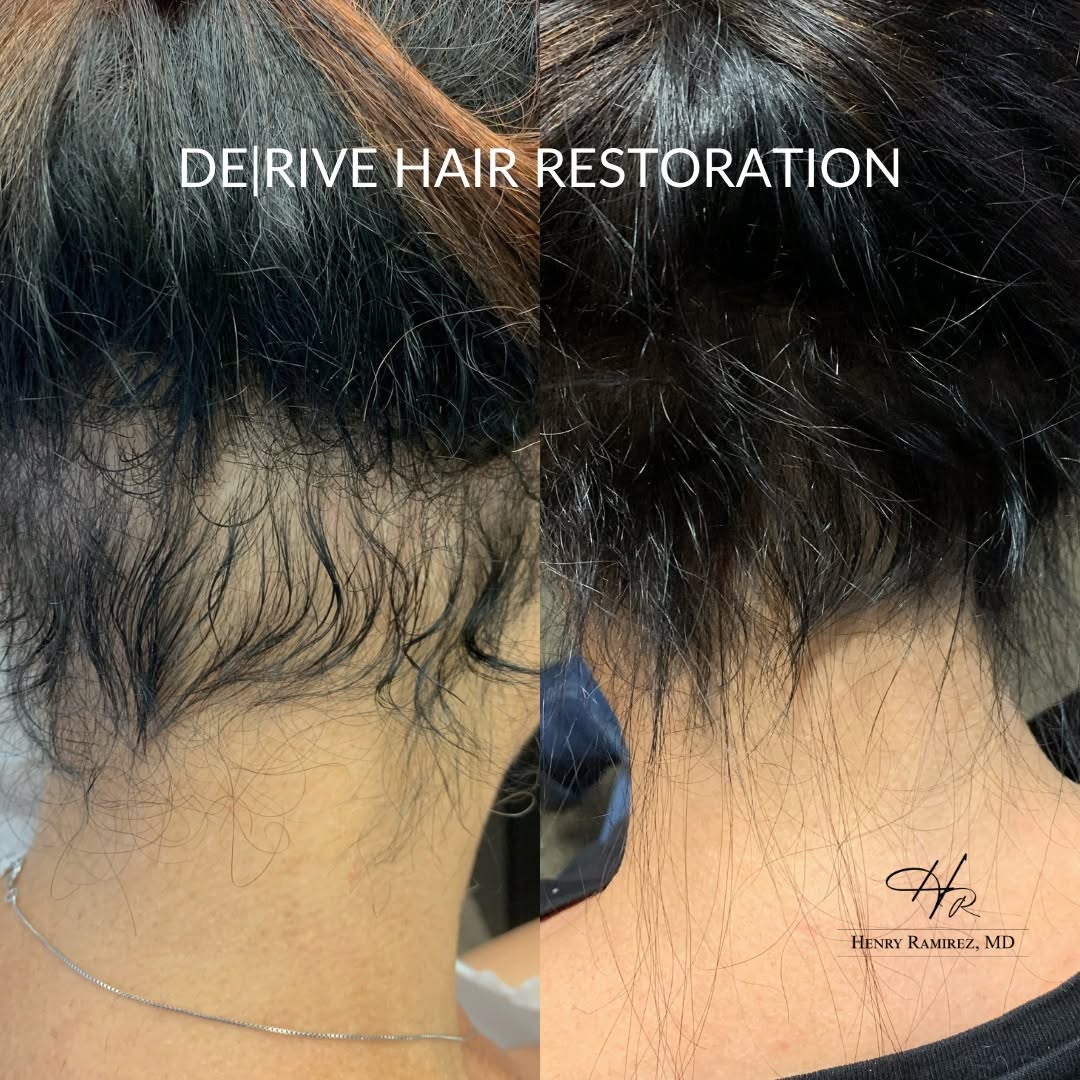 Instagram post by Dr. Henry Ramirez: 🌱 Experience the transformative journey from before to after with De|Rive hair restoration, leading to fuller, revitalized hair. 🌟 Confide…