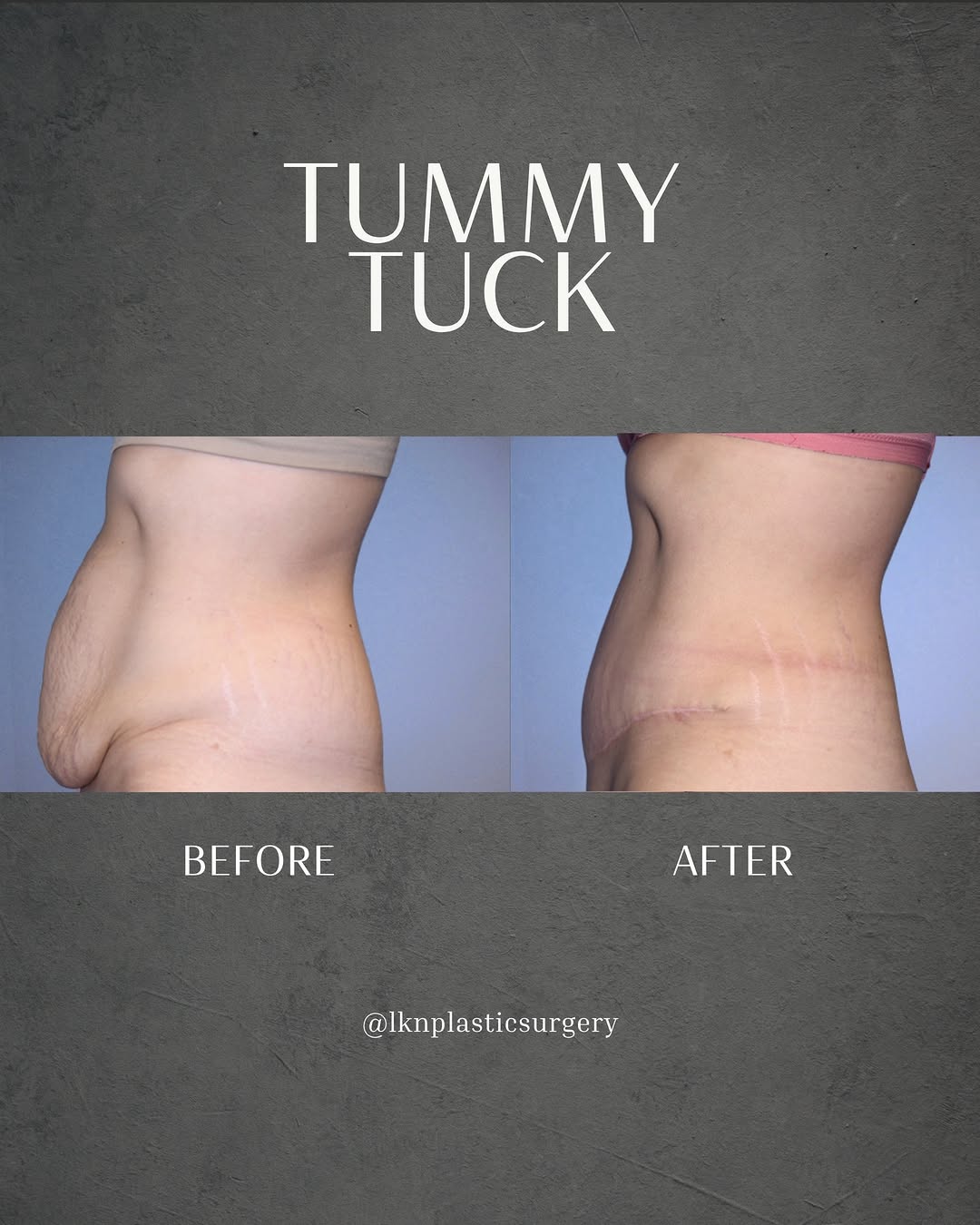 Instagram post by Dr. Henry Wilson: A flat abdomen can still be difficult to achieve after pregnancy, even with a healthy and active lifestyle. This 33-year-old woman was unhap…