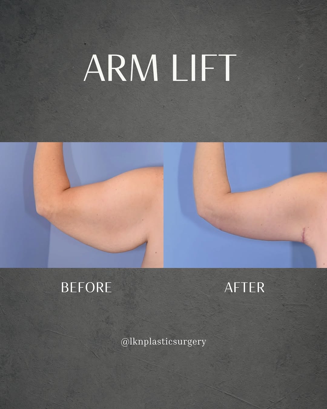 Instagram post by Dr. Henry Wilson: Loose upper-arm skin can change the entire silhouette of the arm, especially after significant weight loss or changes in skin elasticity. Th…