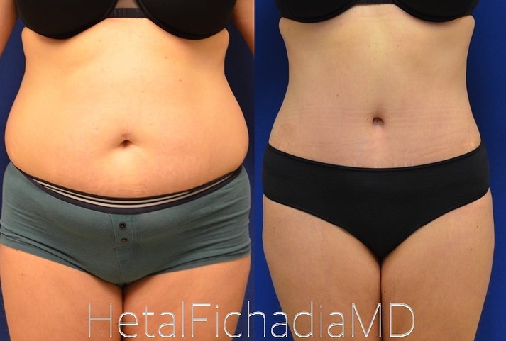 Instagram post by Dr. Hetal Fichadia: 🔥🔥6 weeks after tummy tuck and liposuction. This beautiful patient was frustrated with loose skin and muscle separation that didn’t respon…