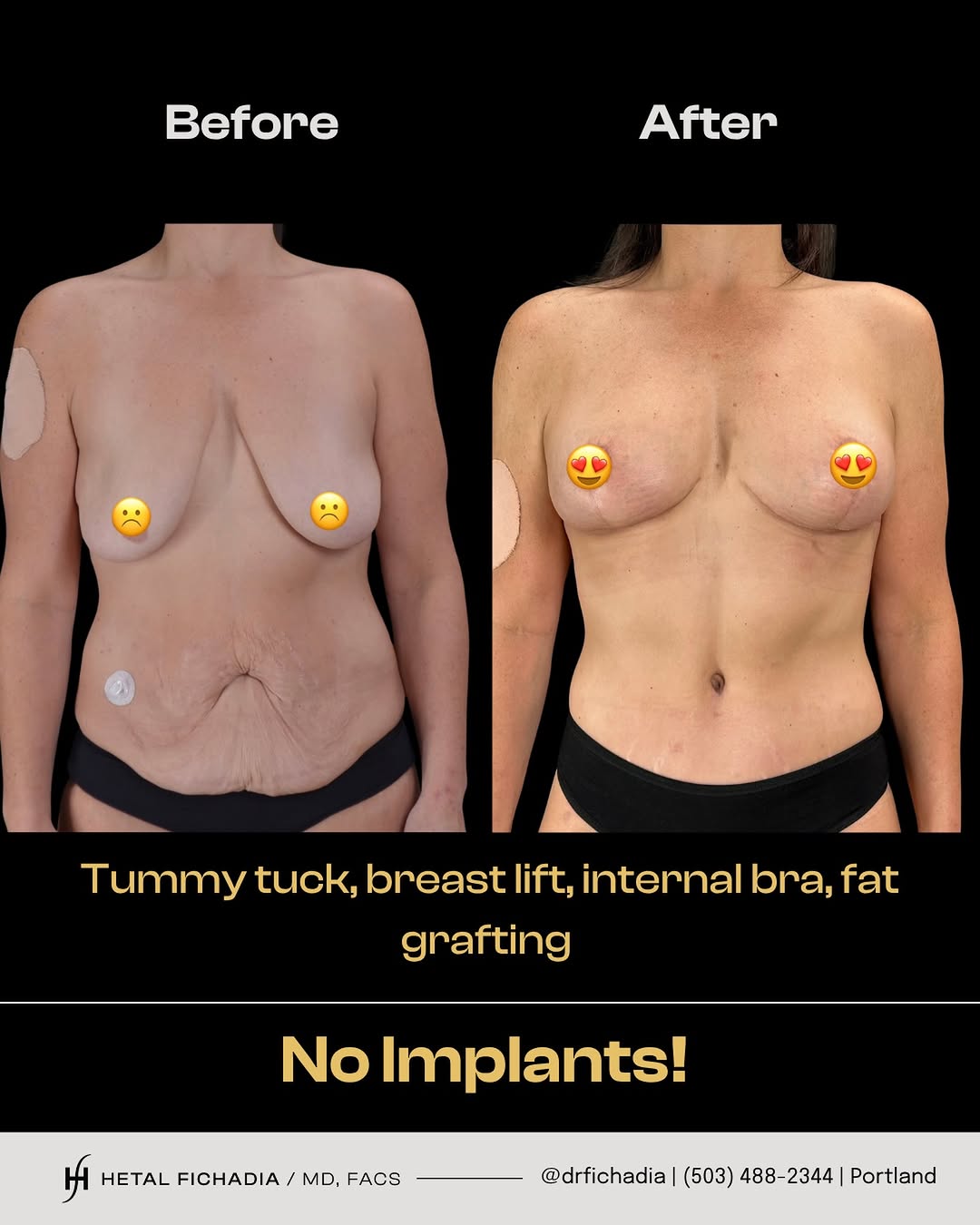 Instagram post by Dr. Hetal Fichadia: After losing more than 90 pounds with the help of a GLP-1 agonist and gastric sleeve surgery, this lovely patient underwent a tummy tuck, br…