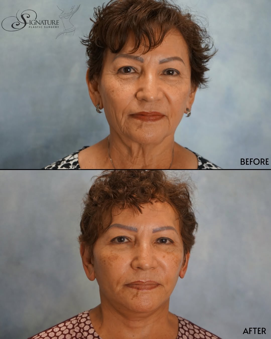 Instagram post by Dr. Himansu Shah: Three weeks post-op. In-office facelift. No general anesthesia. ✦ The results speak for themselves. Dr. Himansu Shah is a board-certified pl…