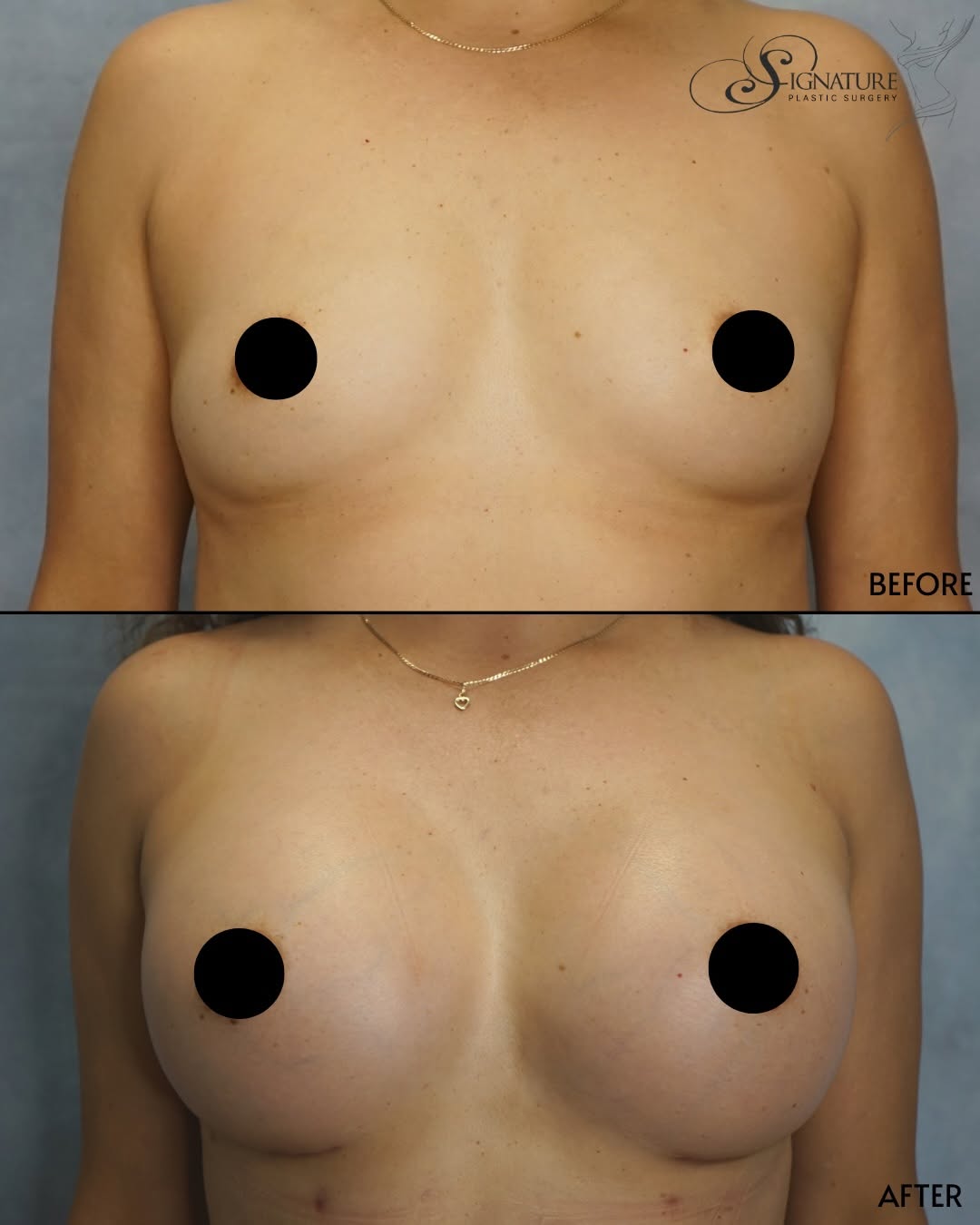 Instagram post by Dr. Himansu Shah: Two months post-op. 550cc silicone breast augmentation with Dr. Shah. ✨ Results like this start with a conversation. Dr. Himansu Shah is a b…