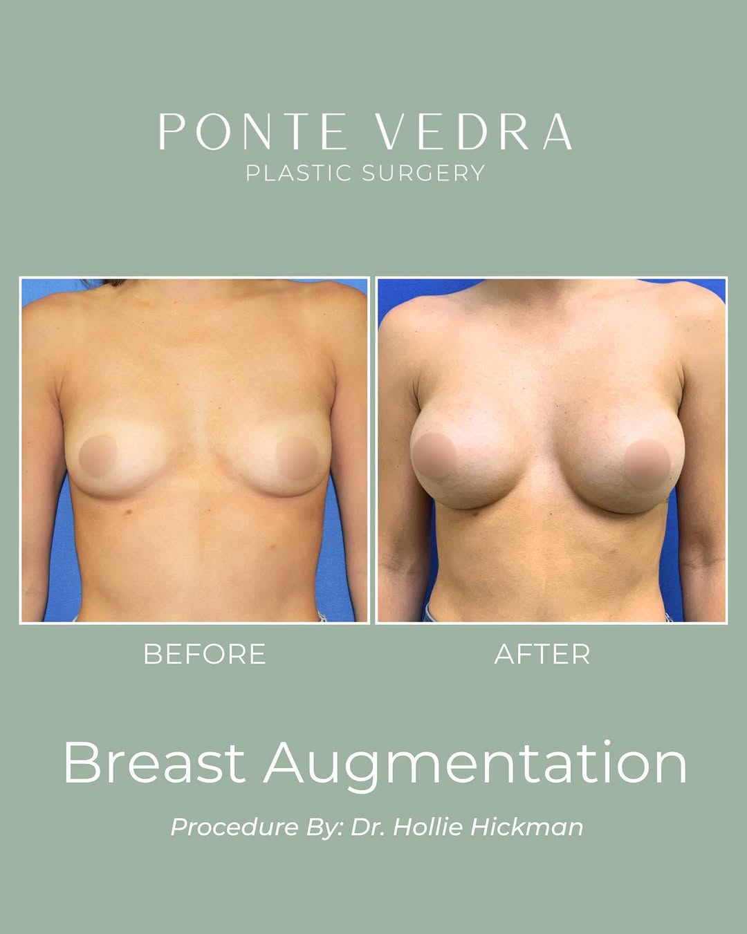 Instagram post by Dr. Hollie Hickman: ONE MORE MONTH TO SAVE ✨ For a limited time, receive $1,000 OFF any* surgical procedure at Ponte Vedra Plastic Surgery. Refined results. Exc…