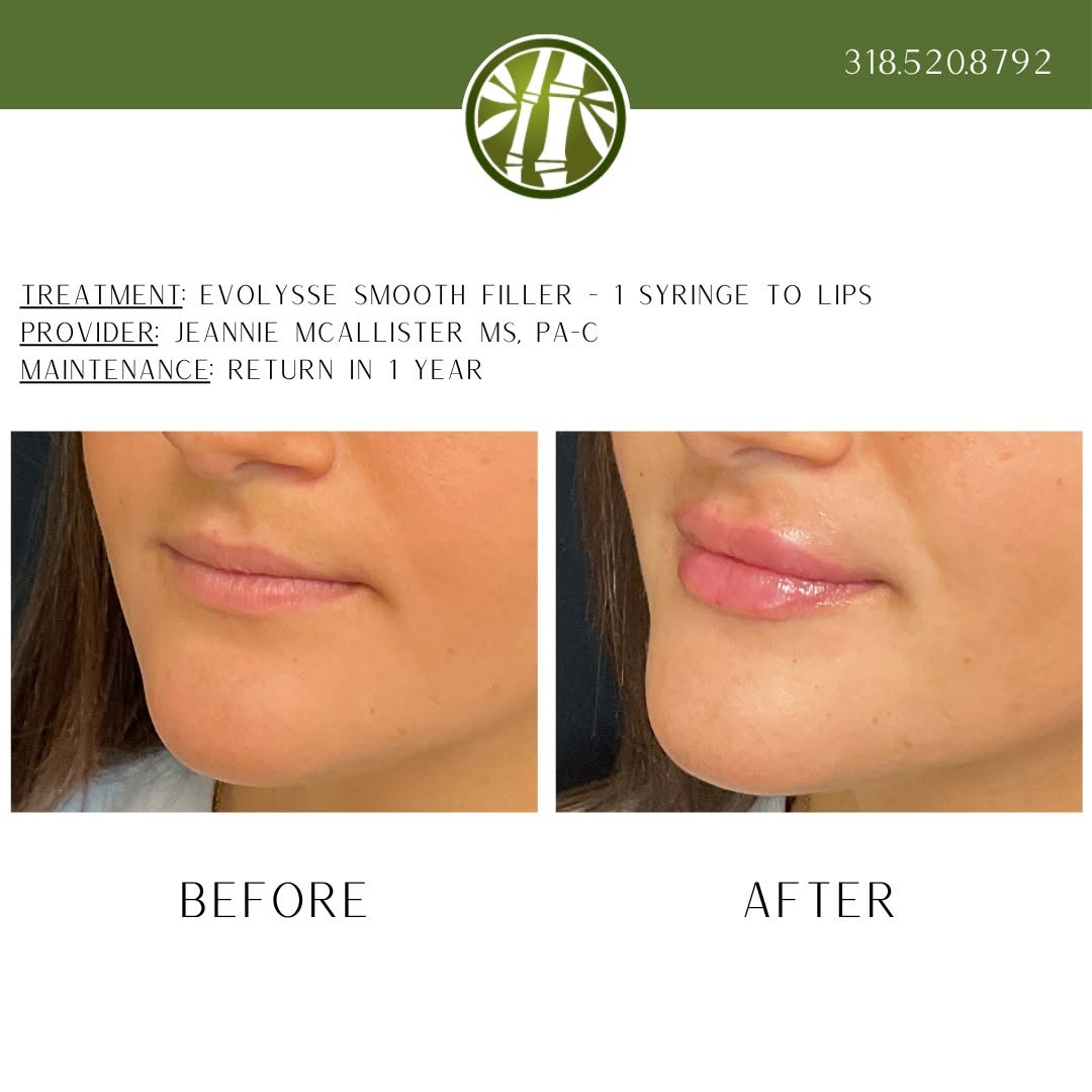 Instagram post by Dr. Holly Casey Wall: Don't sweat the small things. Fill them! Schedule your consultation with Jeannie McAllister MS, PA-C by texting 318.523.2722. #lipfiller #li…