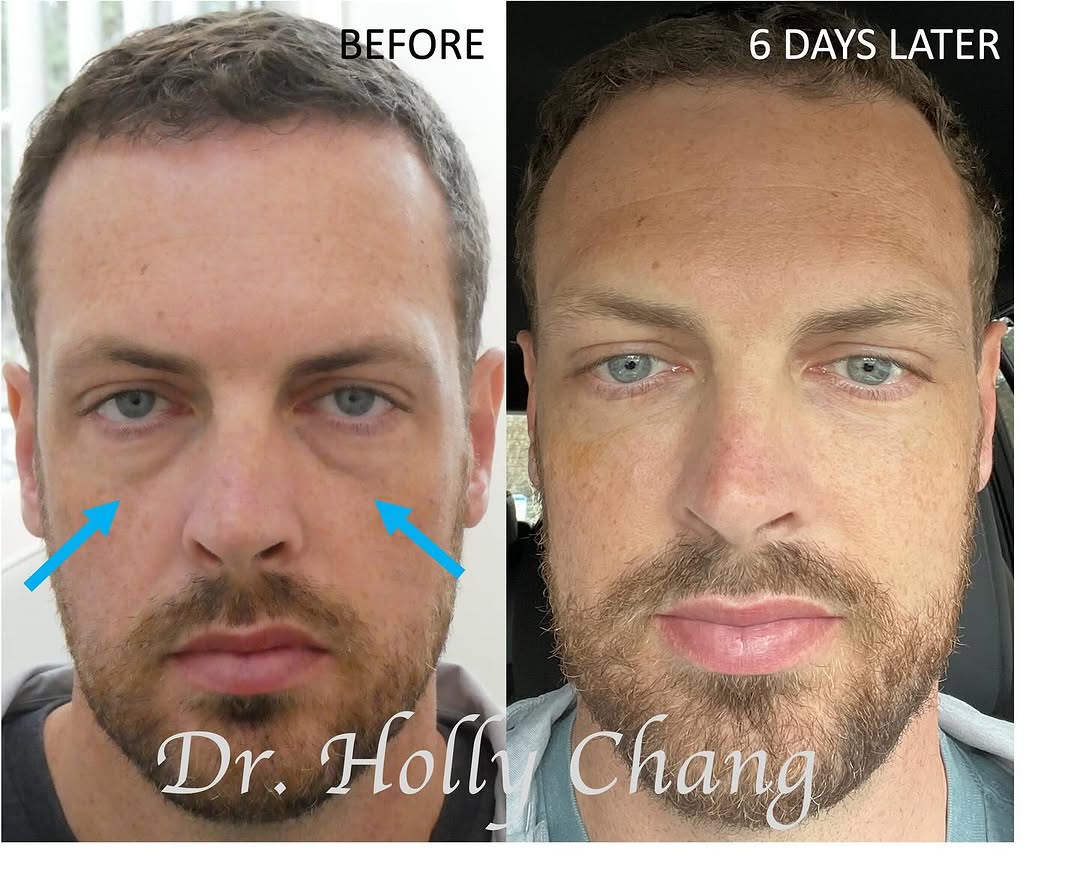 Instagram post by Dr. Holly Chang: So grateful that I was able to help this hard-working young single Dad look less tired despite the stresses of running a successful business…